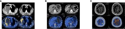 Anlotinib combined with pembrolizumab as first-line treatment for advanced pulmonary sarcomatoid carcinoma: a case report and literature review